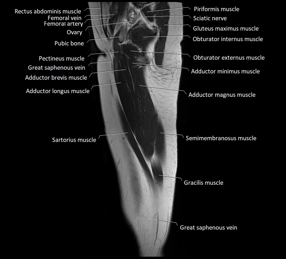 Thigh sagittal cross sectional anatomy MRI 3T image 17.webp